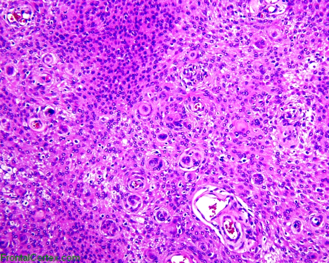 Meningioma (WHO GRADE I), H&E stain x40